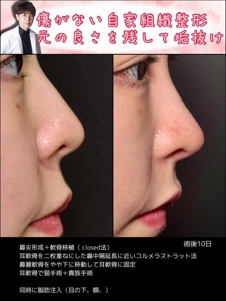 クローズド法の鼻尖形成と軟骨移植の症例写真 (3)