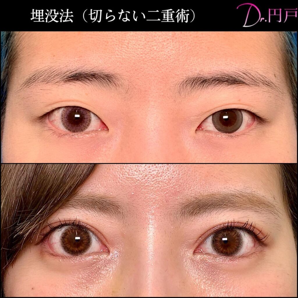 埋没法とタレ目形成の症例写真