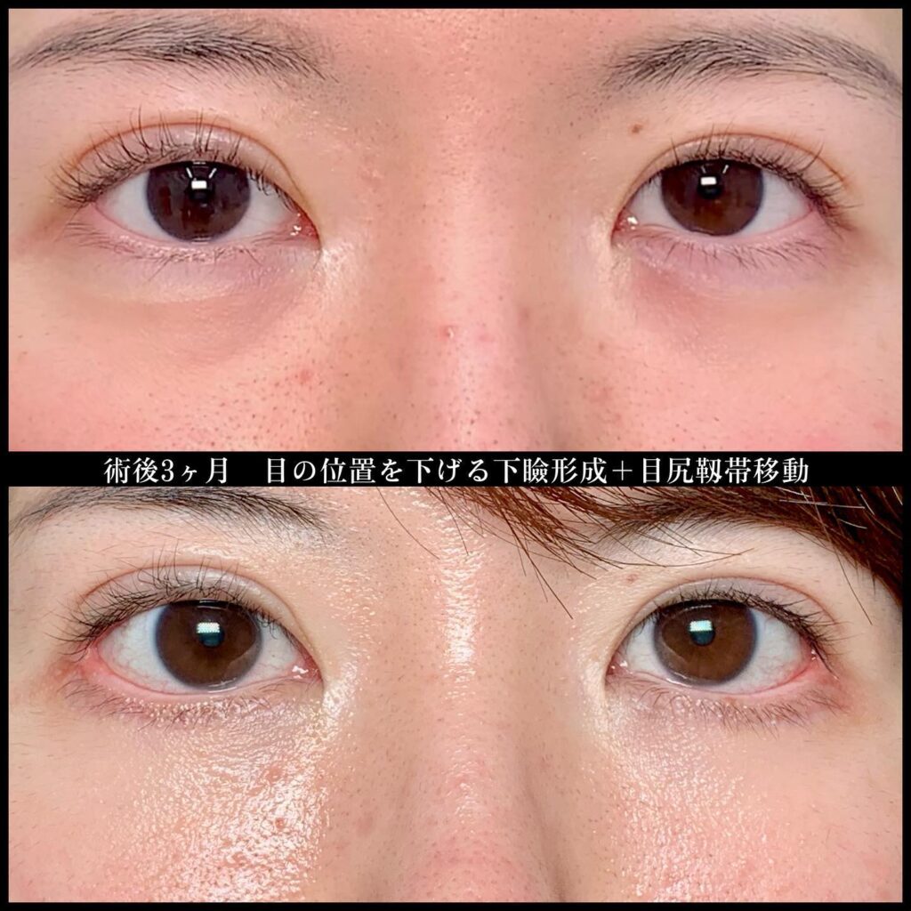 下瞼拡大と目尻靭帯移動の症例写真 (2)
