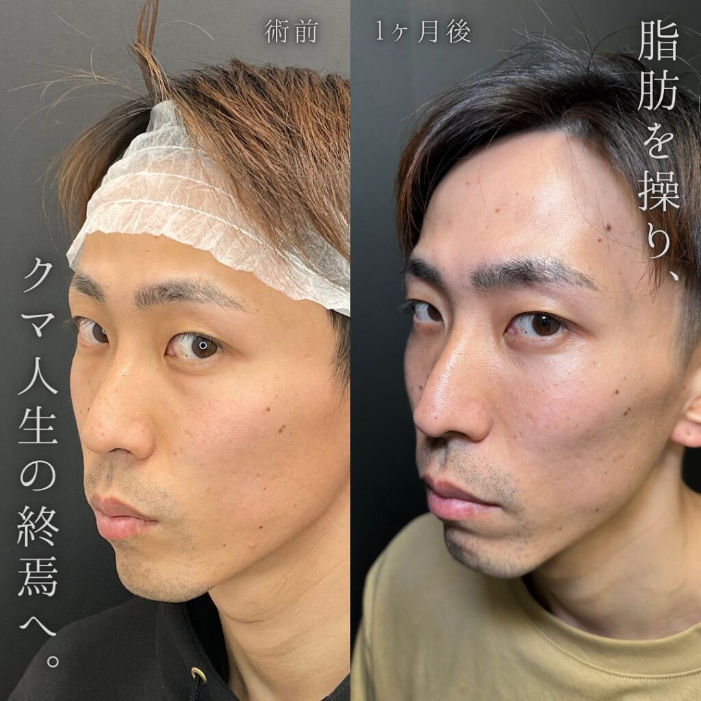 eクリニック経結膜脱脂と脂肪注入をした男性の症例