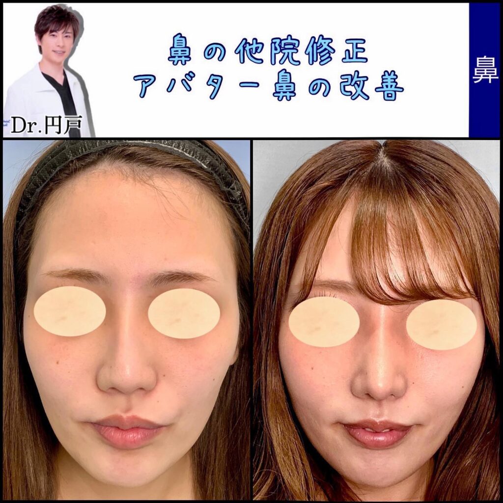 鼻の他院修正の症例写真 (2)