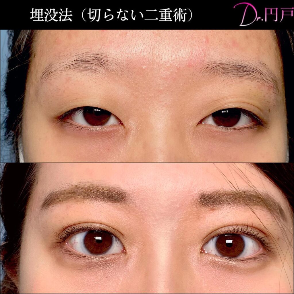 埋没法の症例写真 (10)