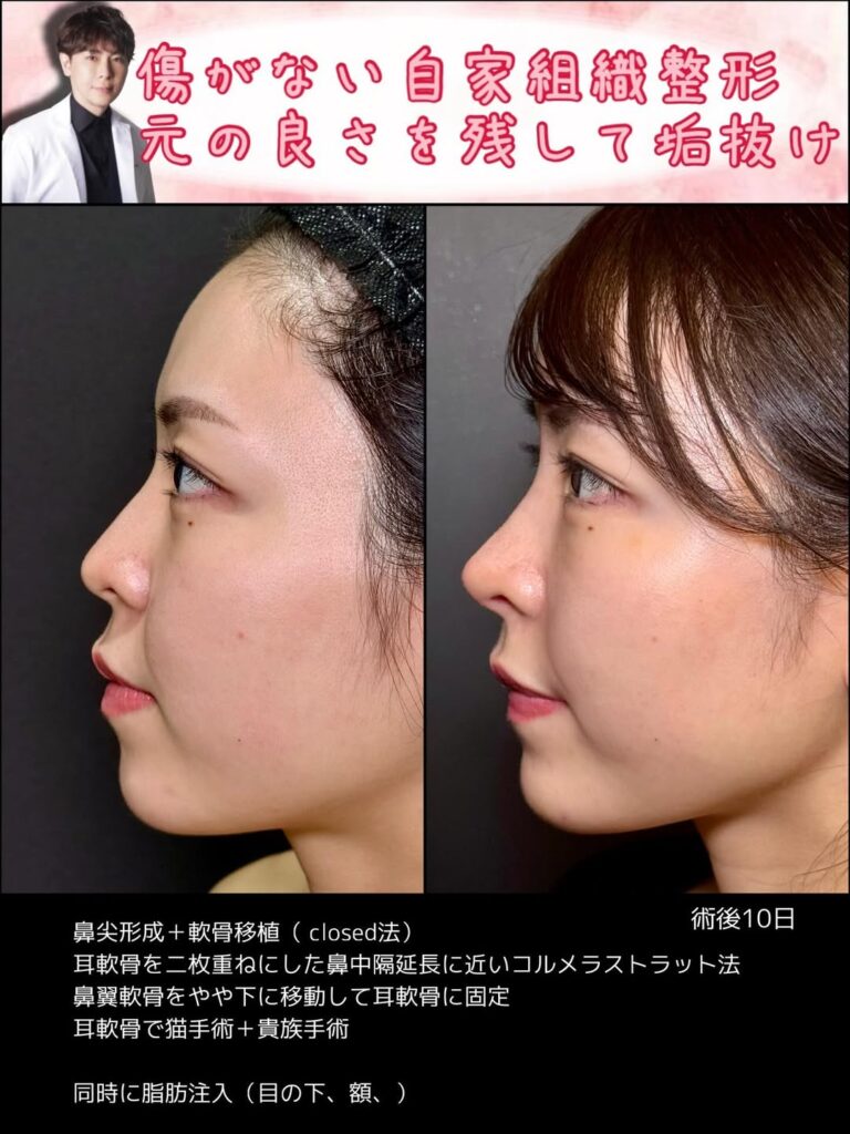 クローズド法の鼻尖形成と軟骨移植の症例写真 (9)