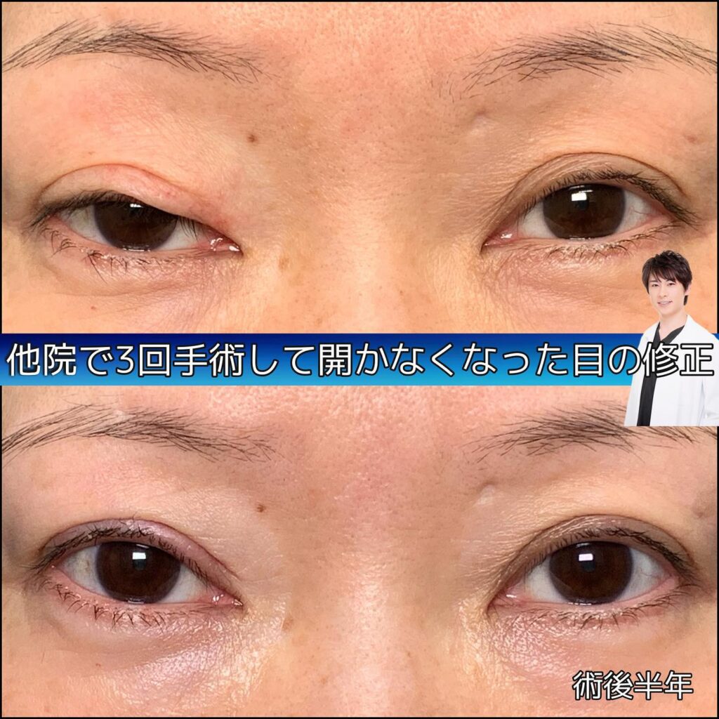 目元の他院修正の症例写真