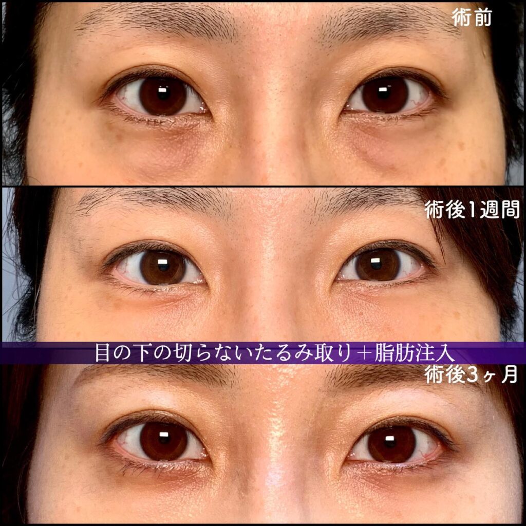 切らない目の下のたるみ取りと脂肪注入の症例写真
