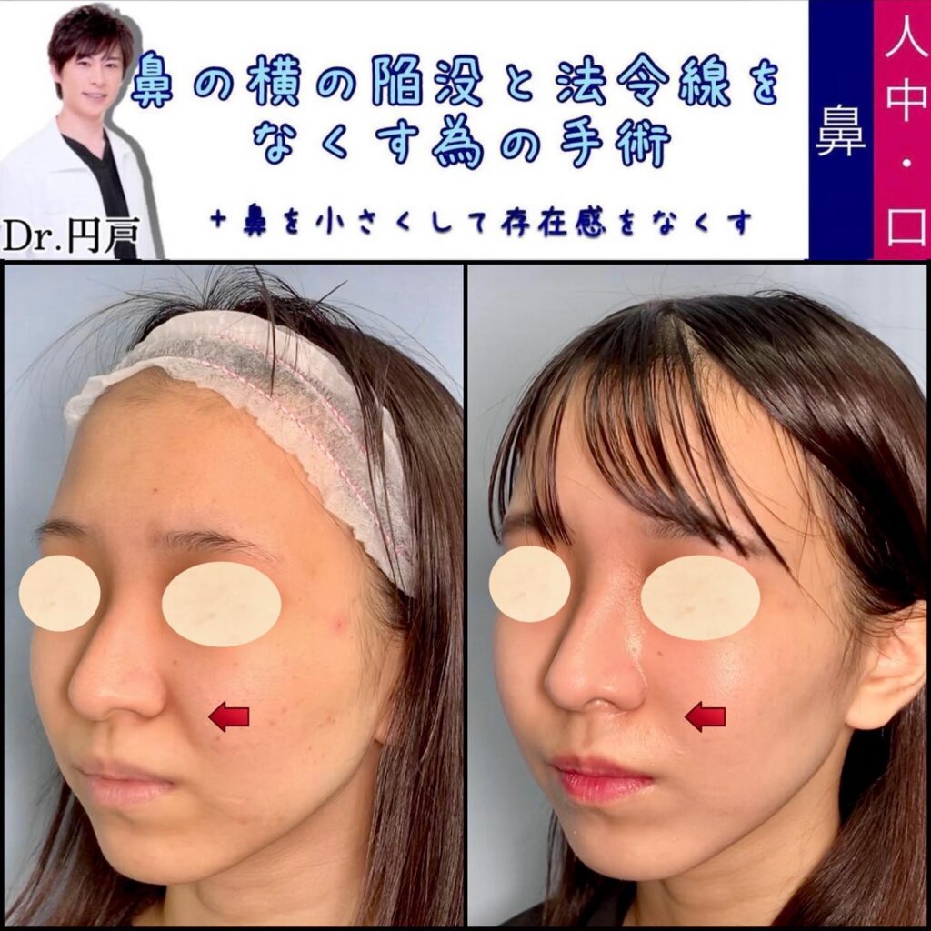 貴族手術の症例写真 (4)