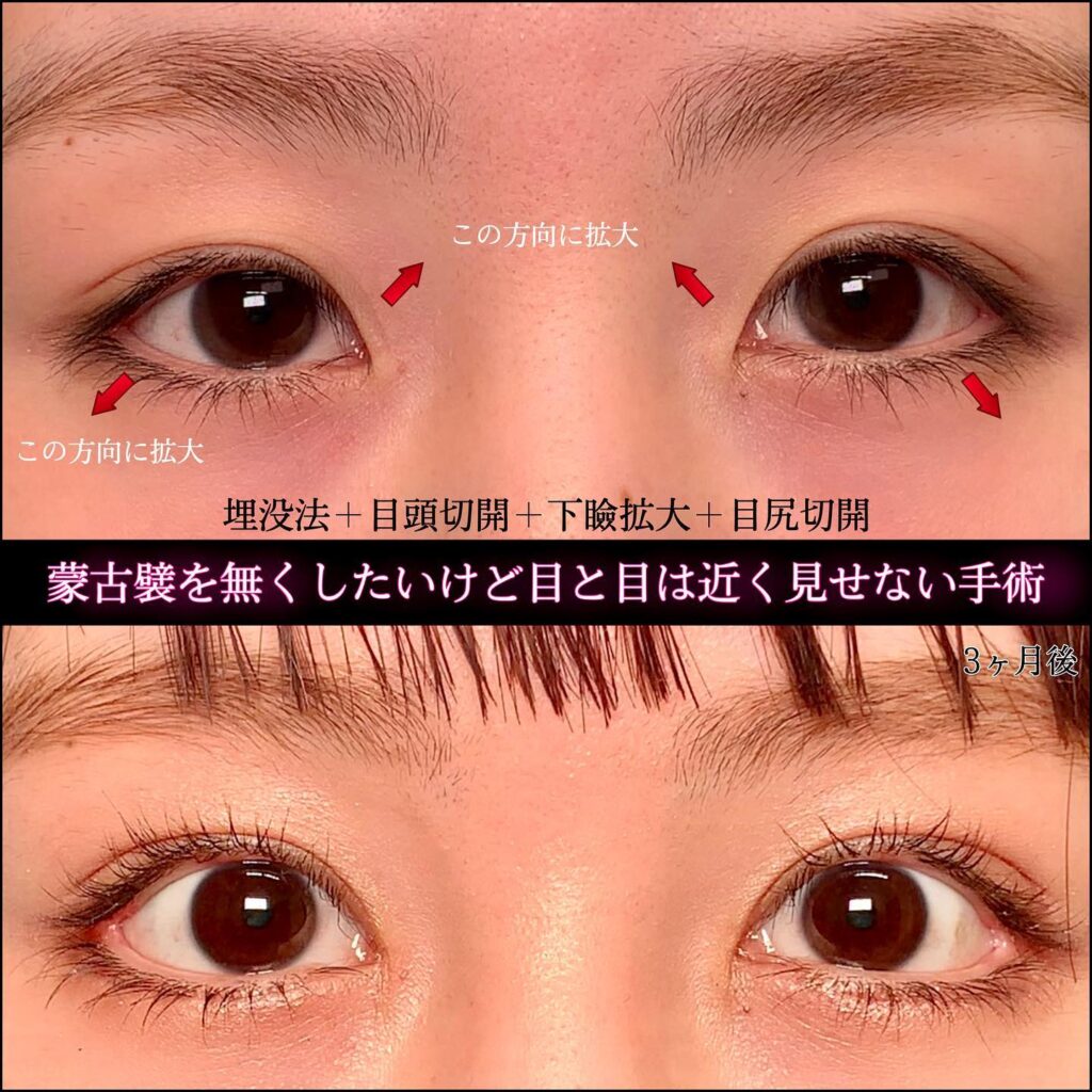埋没法と目頭切開とタレ目形成と目尻切開の症例写真