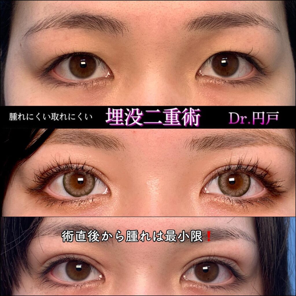 埋没法の症例写真 (20)