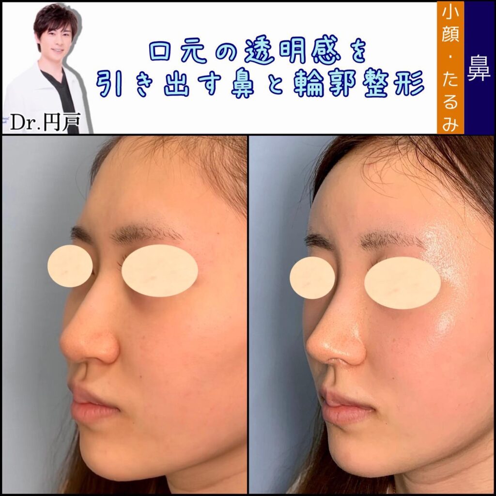 鼻中隔延長と輪郭形成の症例写真 (1)