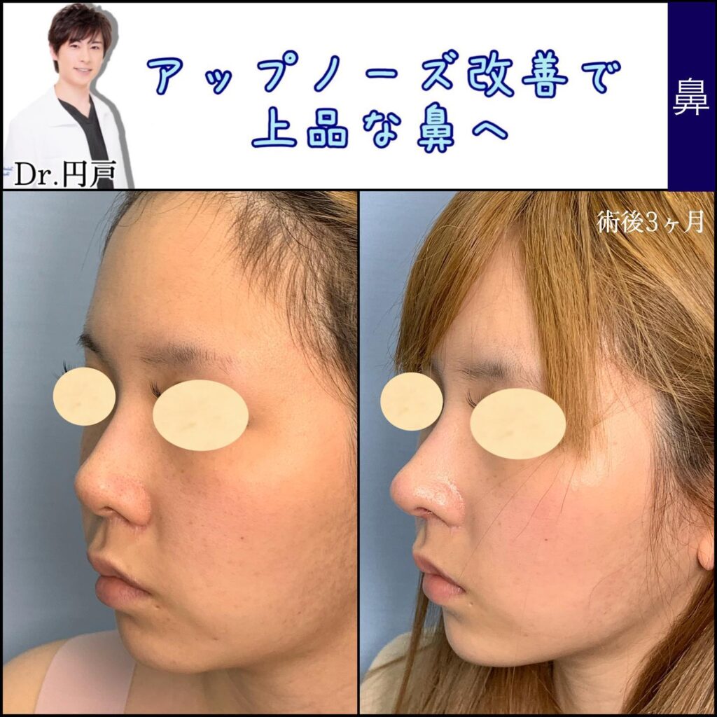 鼻中隔延長の症例写真 (5)