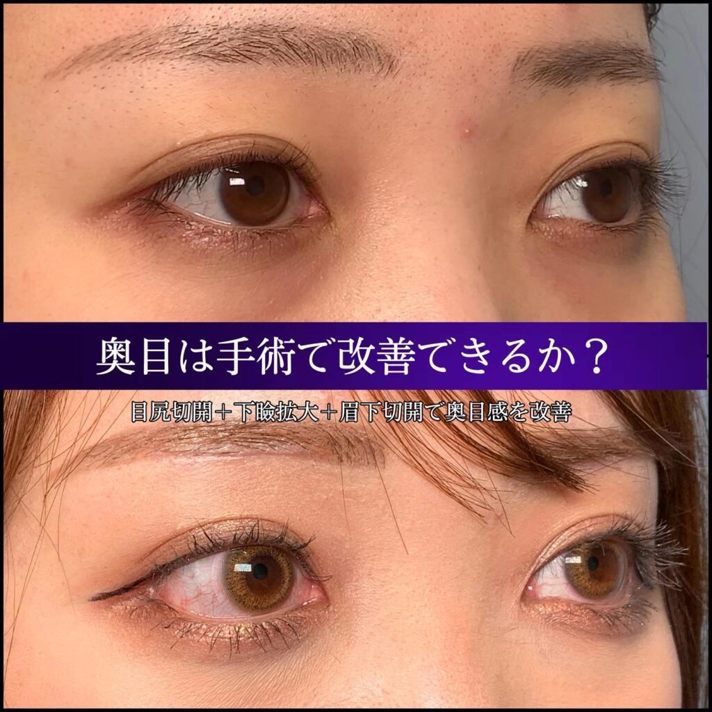 目尻切開とタレ目形成と眉下切開の症例写真 (1)