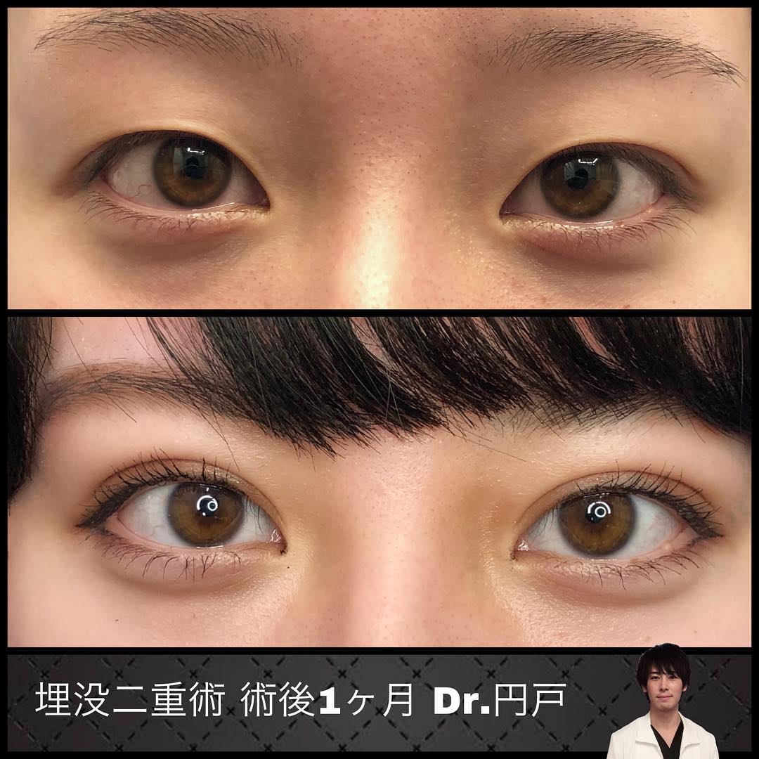 埋没法の症例写真 (27)