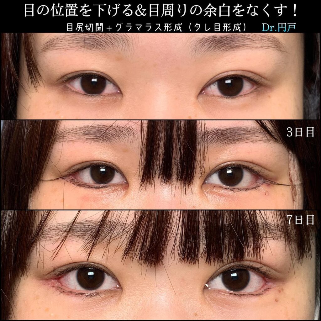 目尻切開とタレ目形成の症例写真 (3)