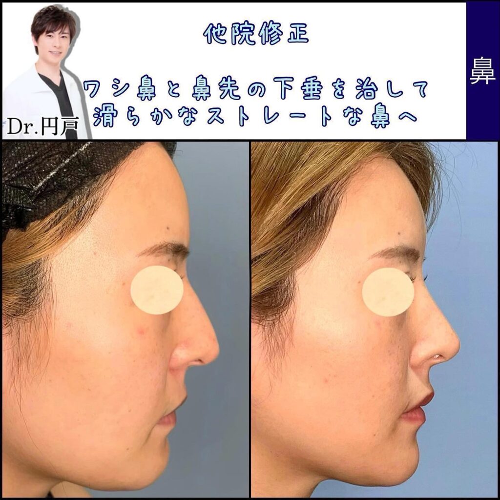 鼻の他院修正の症例写真 (6)