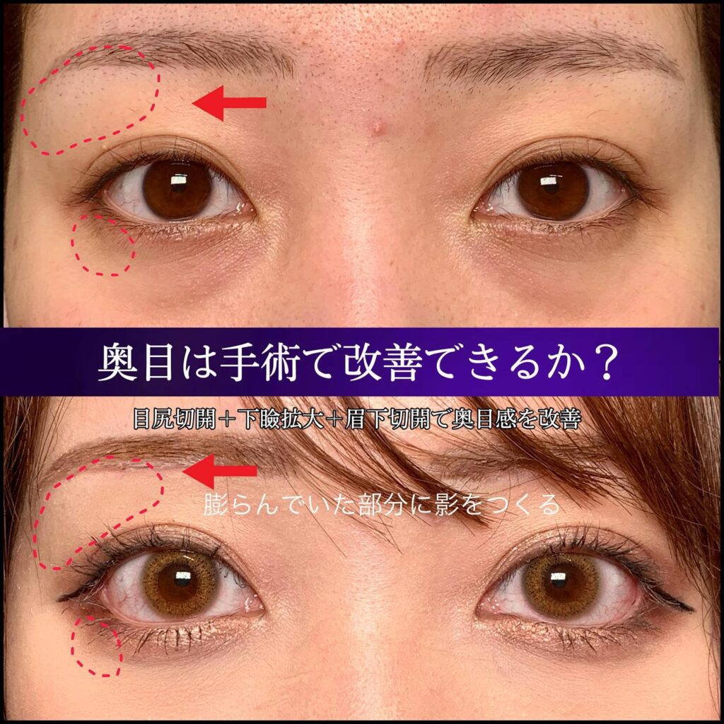 目尻切開とタレ目形成と眉下切開の症例写真 (2)
