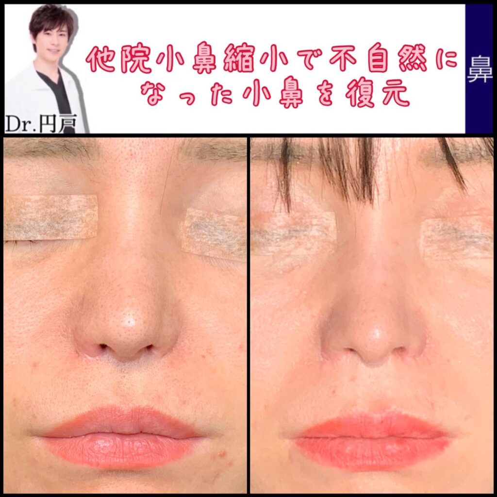 鼻翼拡大修正術の症例写真 (2)