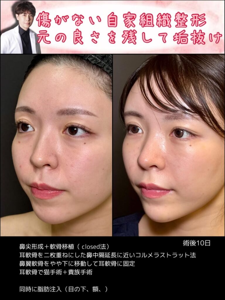 クローズド法の鼻尖形成と軟骨移植の症例写真 (10)