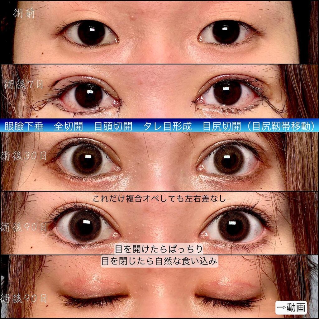 眼瞼下垂と全切開と目頭切開とタレ目形成と目尻切開の症例写真 (1)