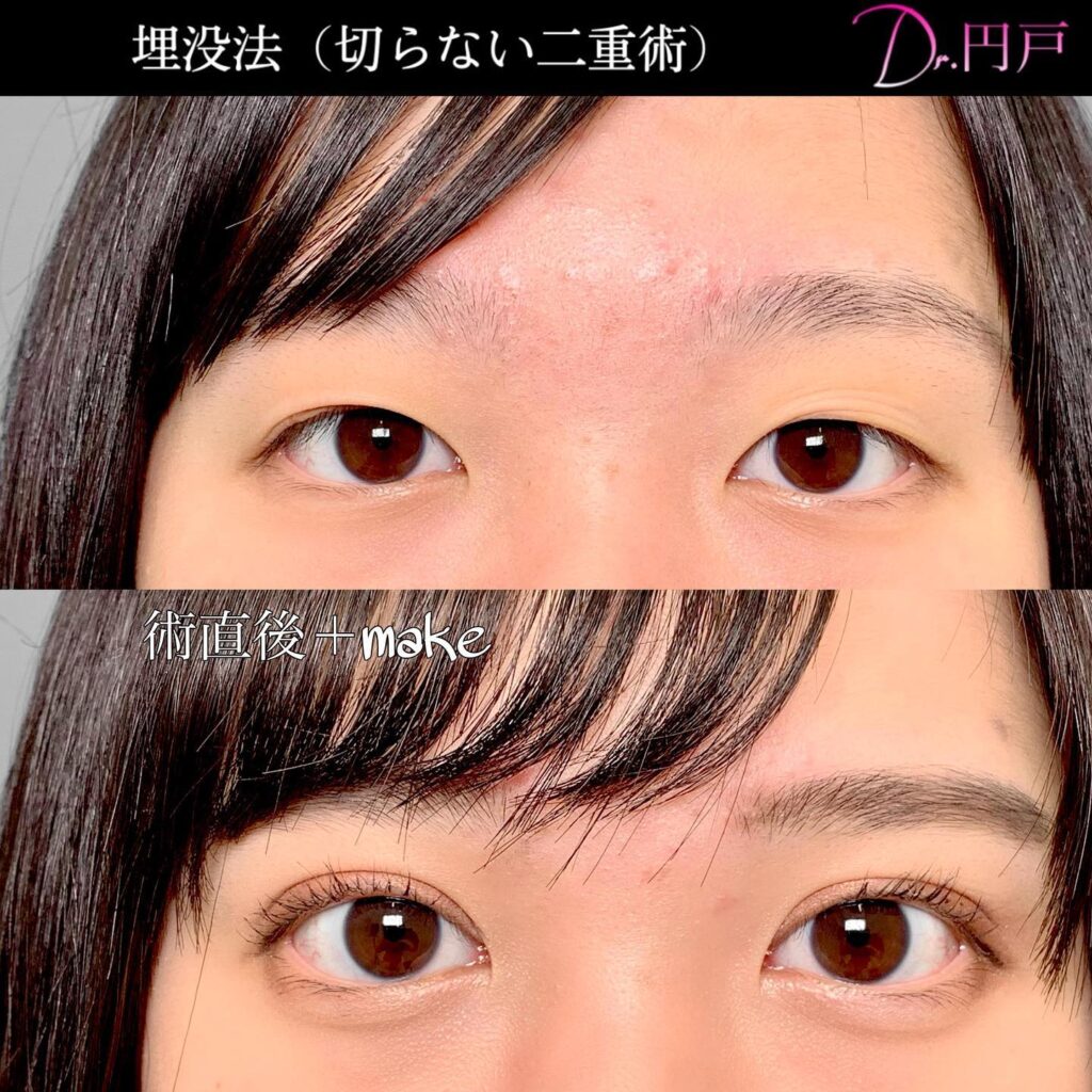 埋没法の症例写真 (29)