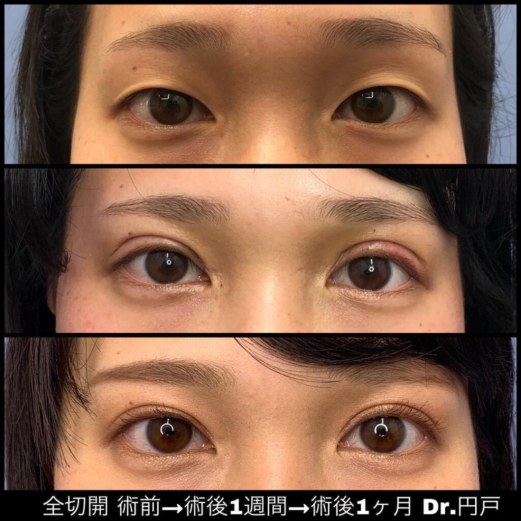 全切開の症例写真