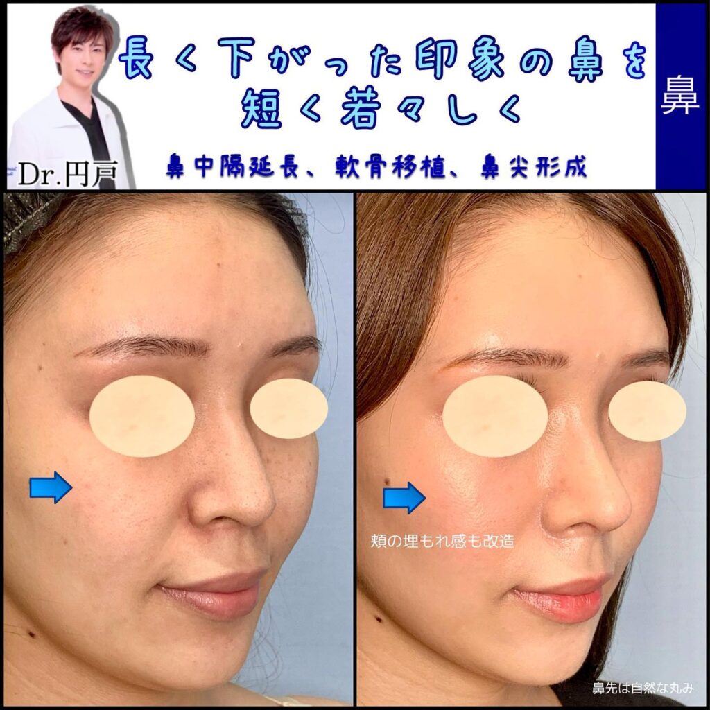 鼻中隔延長と軟骨移植と鼻尖形成の症例写真 (1)