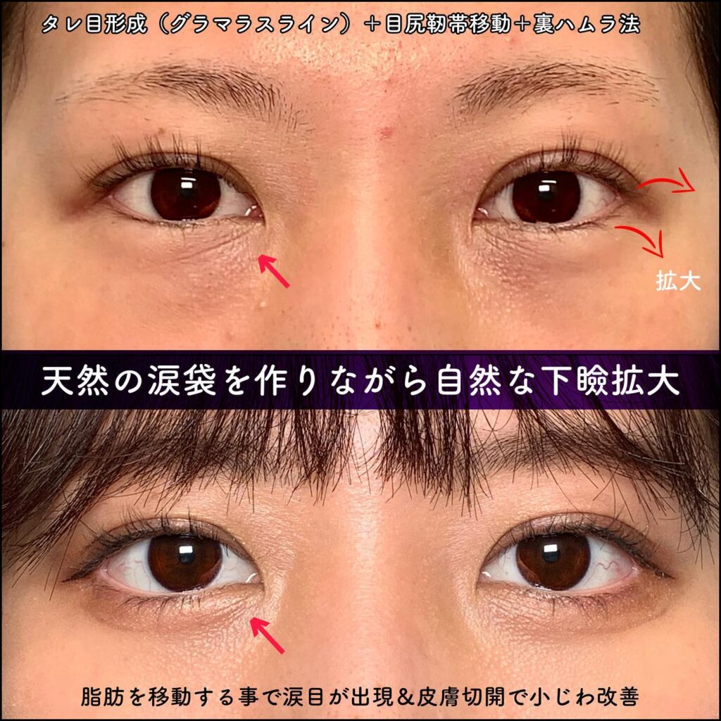タレ目形成と目尻靭帯移動と裏ハムラ法の症例写真 (1)