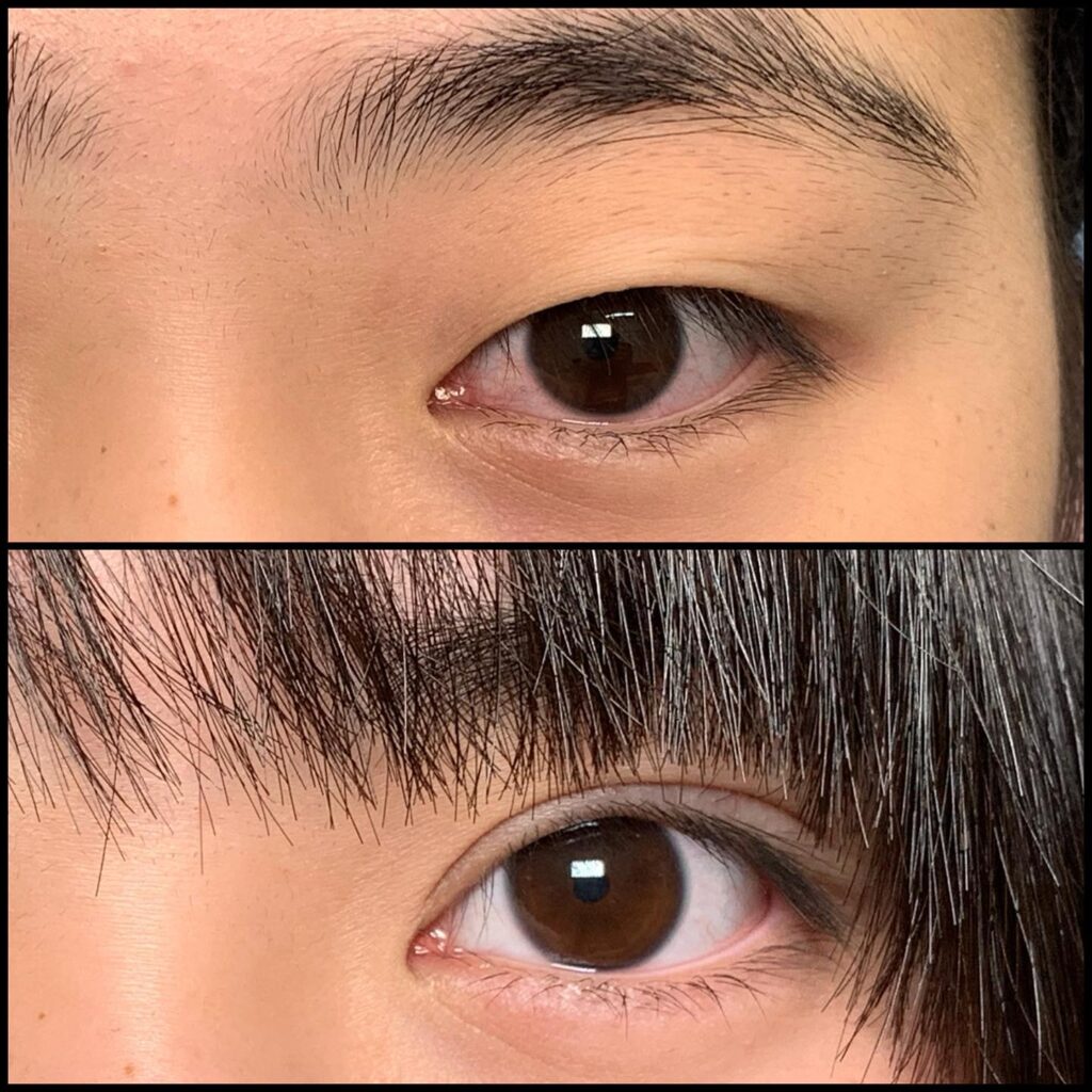 埋没法の症例写真 (18)