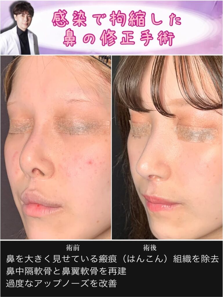 感染で拘縮した鼻を鼻中隔軟骨と鼻翼軟骨で再建した修正手術 (2)