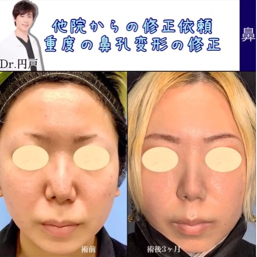 重度の鼻の修正手術