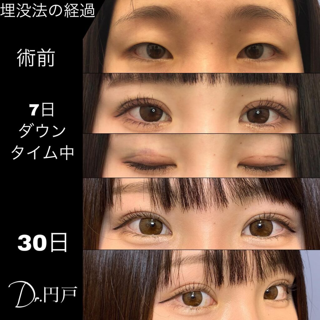 埋没法のダウンタイムの経過の症例