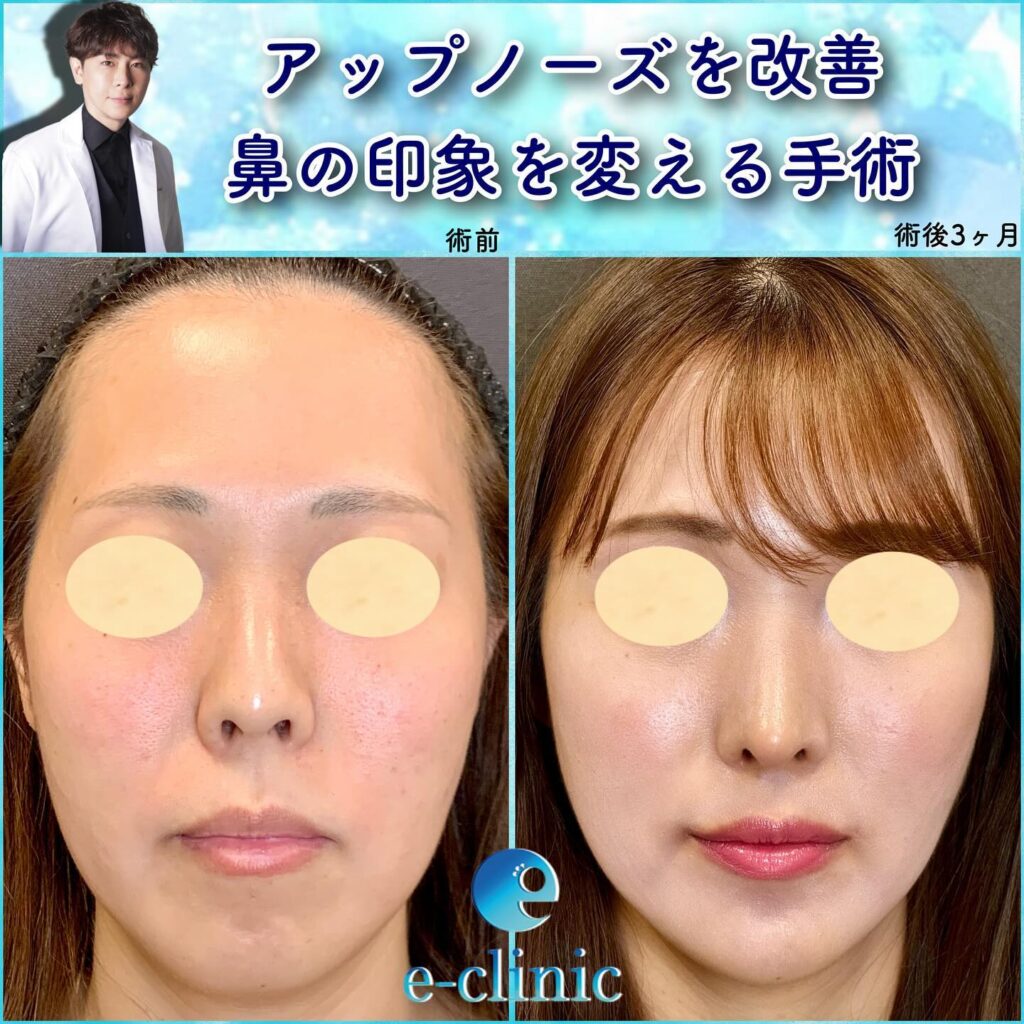 鼻尖形成と軟骨移植と鼻中隔延長と口角挙上と顎のヒアルロン酸の症例写真 (1)