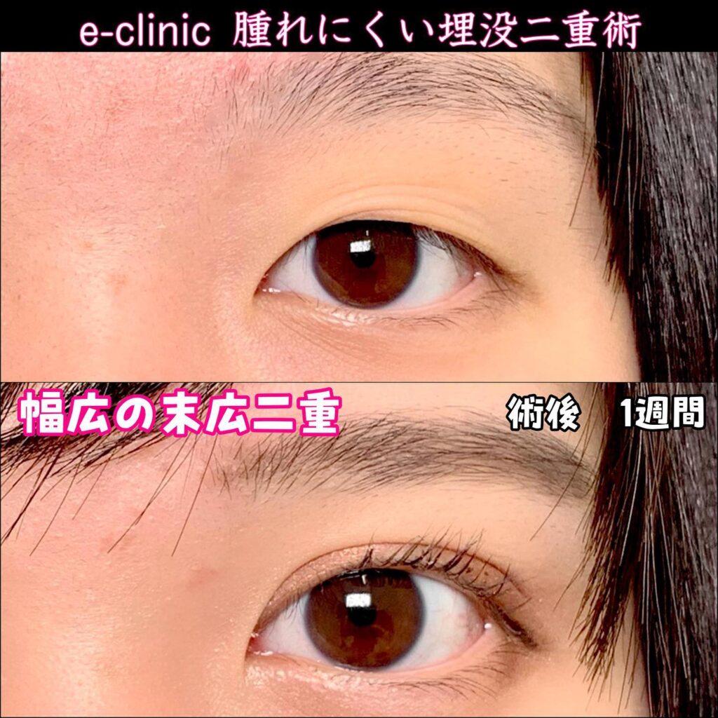 埋没法の症例写真 (12)