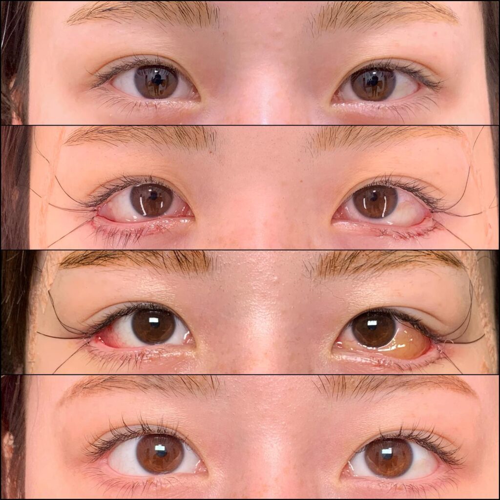 タレ目形成と目尻切開の症例写真 (2)