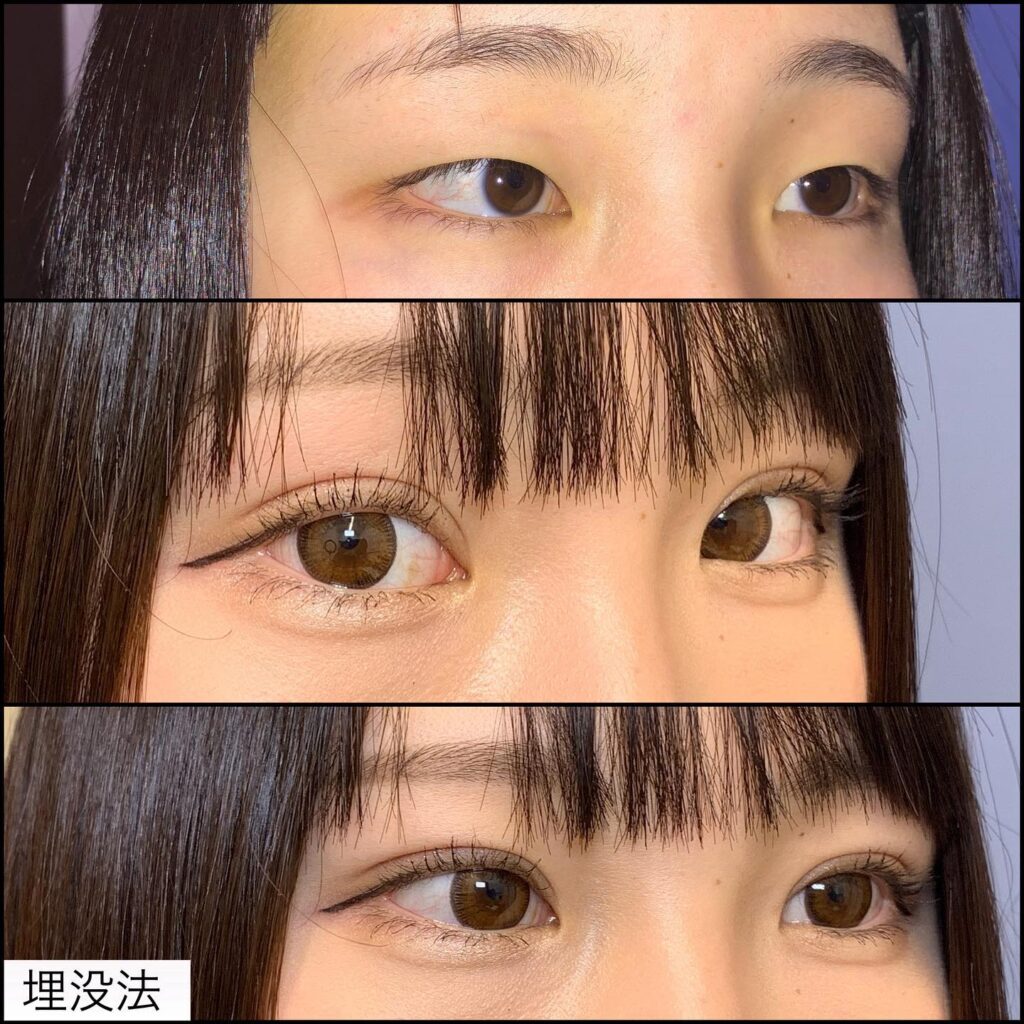 埋没法の症例写真 (8)