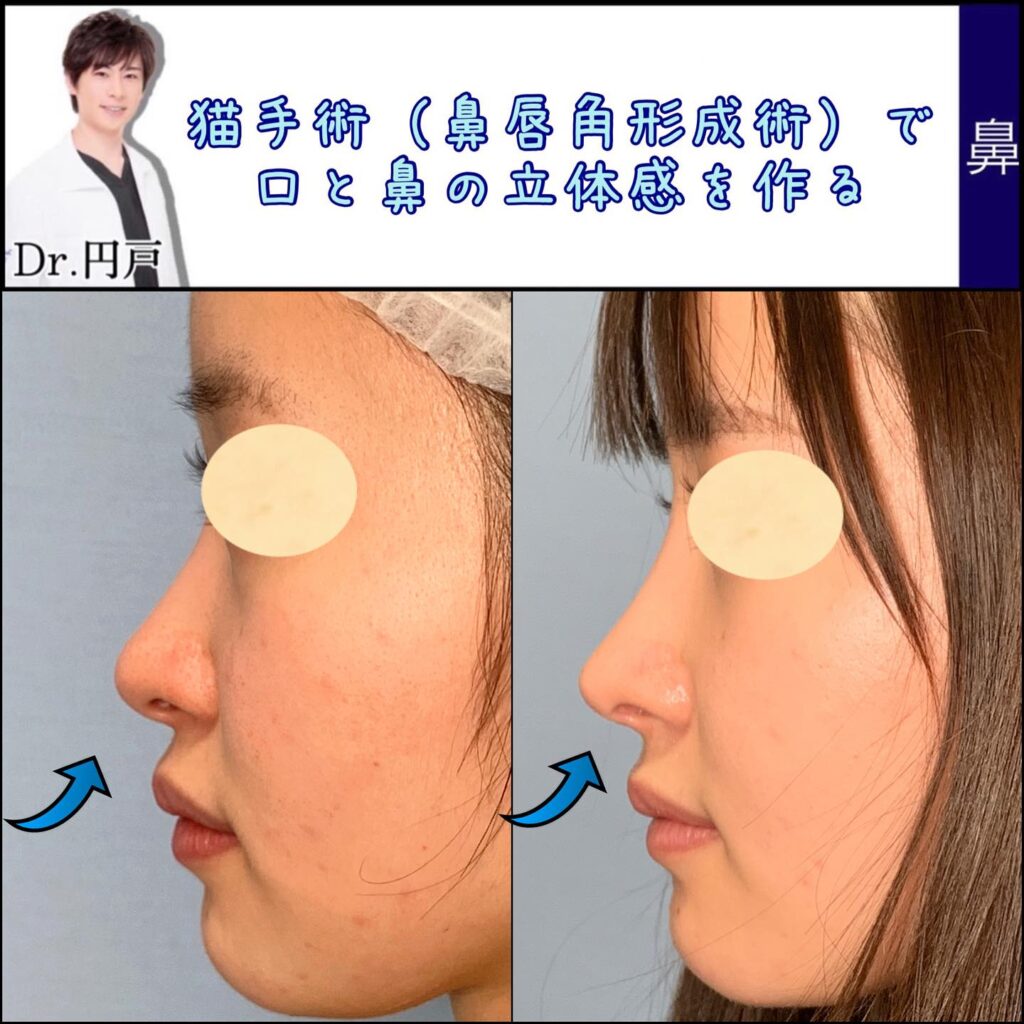 鼻唇角形成術の症例写真 (1)