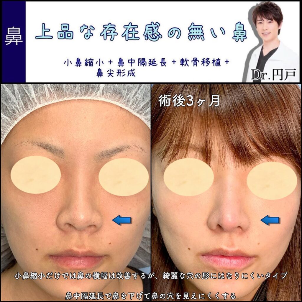 小鼻縮小と鼻中隔延長と軟骨移植と鼻尖形成の症例写真
