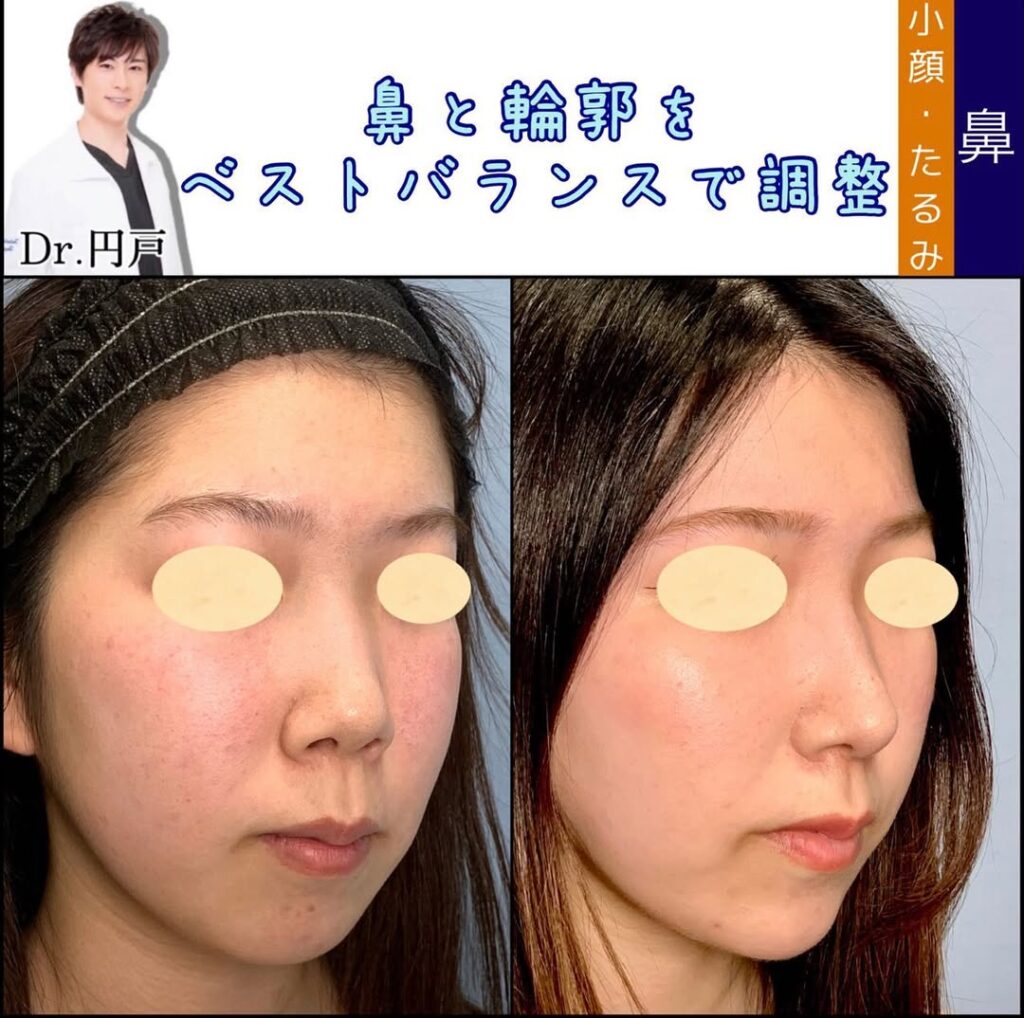 鼻中隔延長と美廃部軟骨移植と鼻尖形成と軟骨移植と輪郭形成と顎のヒアルロン酸の症例写真 (3)