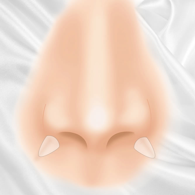 貴族手術のイメージ