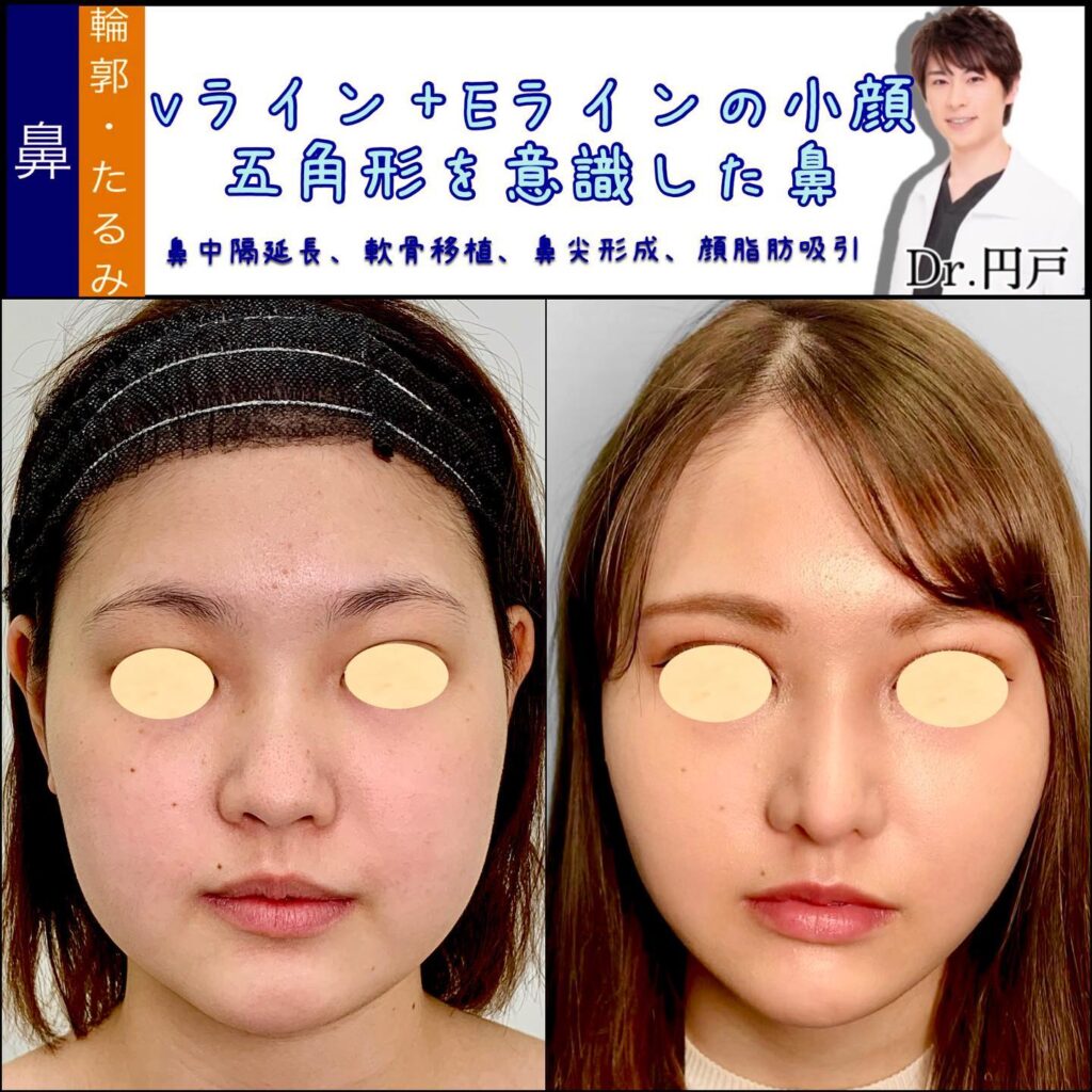 鼻中隔延長と軟骨移植と鼻尖形成と小顔脂肪吸引の症例写真 (2)