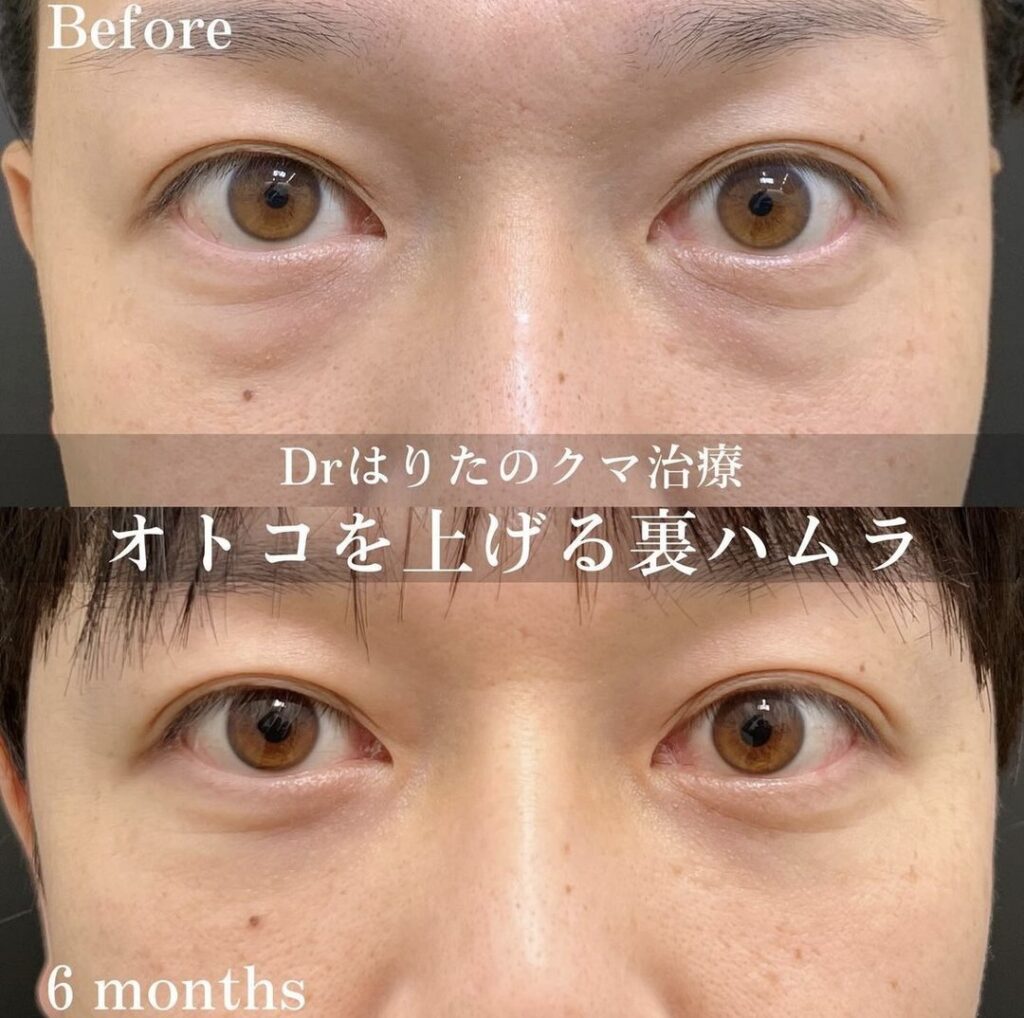 京都の男性の裏ハムラ法の症例