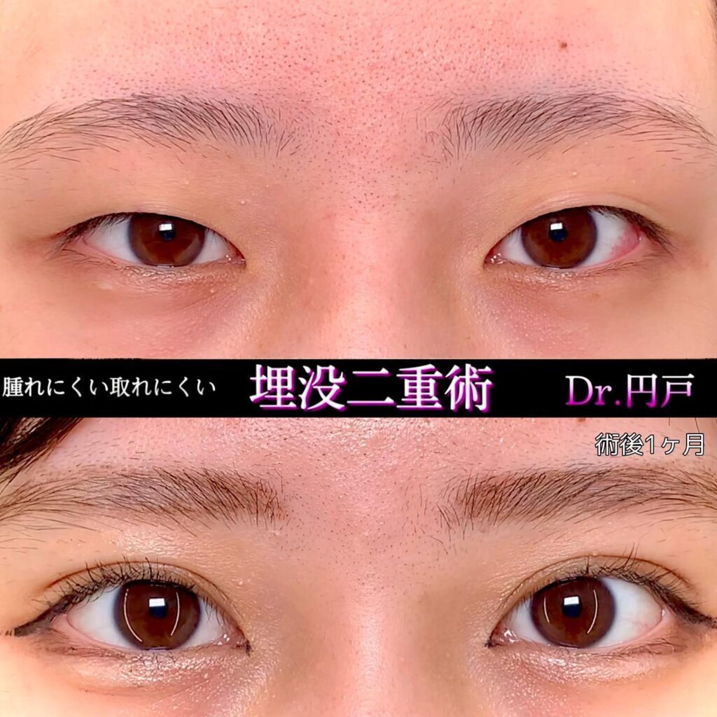 埋没法の症例写真 (22)