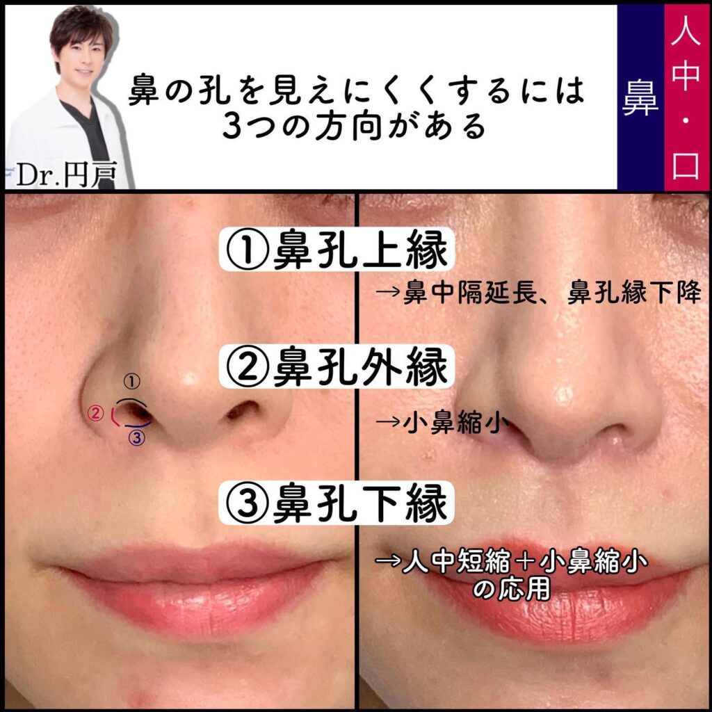 人中短縮と小鼻縮小の症例写真 (3)