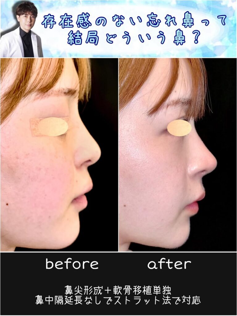 鼻尖形成と軟骨移植単独の症例写真 (2)