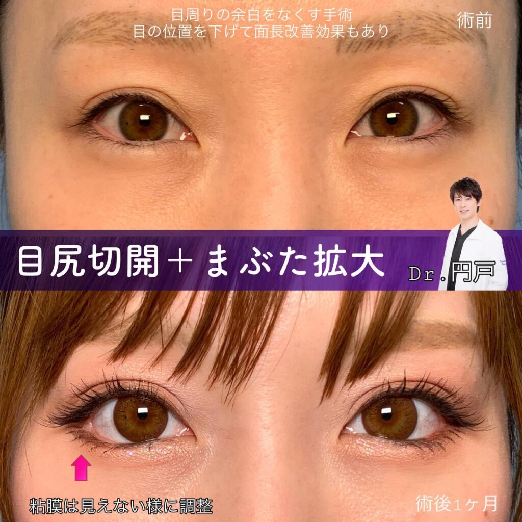 目尻切開とタレ目形成の症例写真 (2)