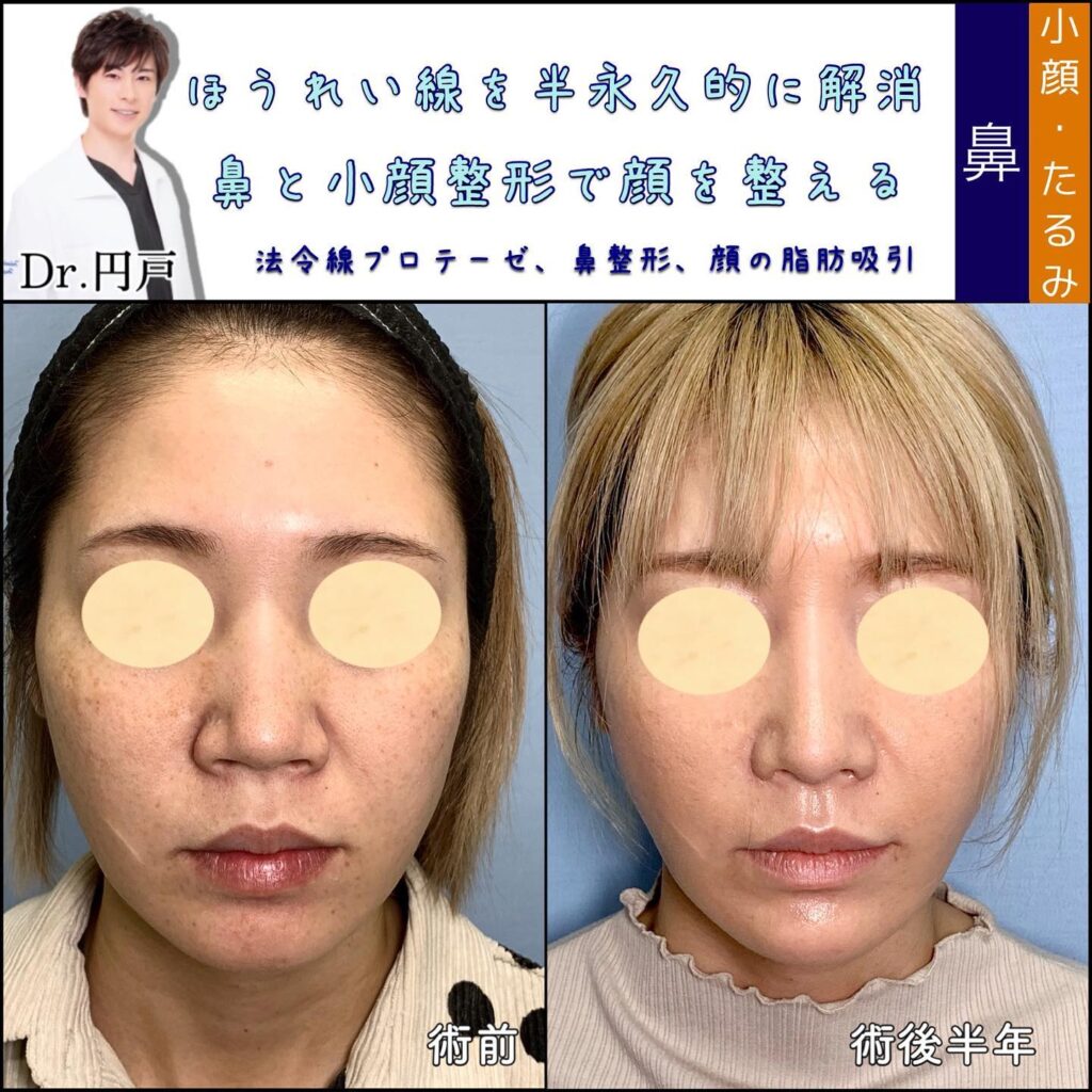 貴族手術と小顔脂肪吸引の症例写真 (2)