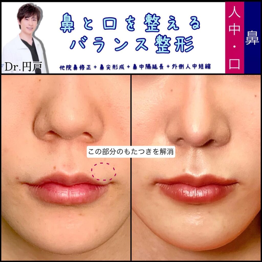 他院の鼻整形と鼻尖形成と鼻中隔延長と外側人中短縮の症例写真 (3)