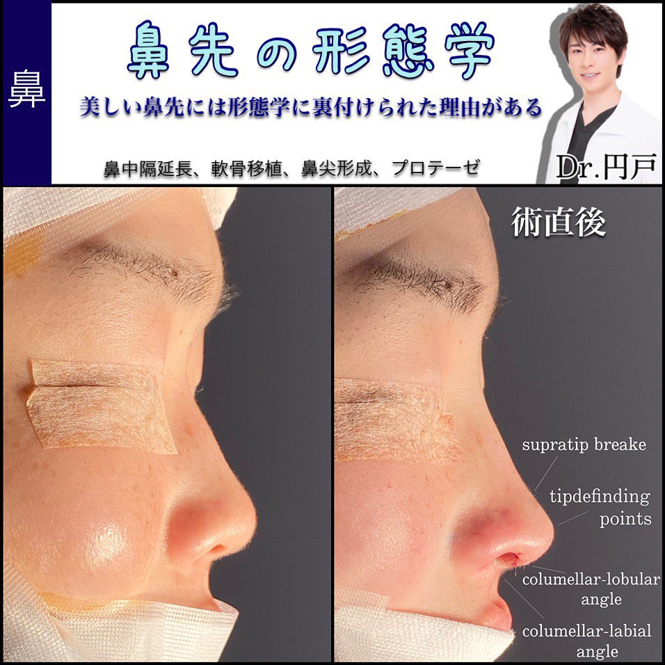 脂肪注入と鼻尖形成と軟骨移植と鼻中隔延長と鼻柱下降と鼻のプロテーゼとヒアルロン酸の症例写真