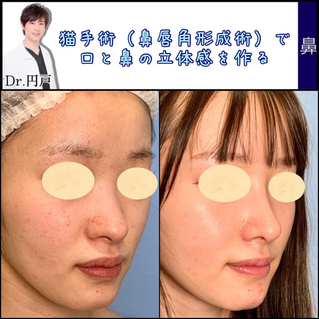 鼻唇角形成術の症例写真 (3)