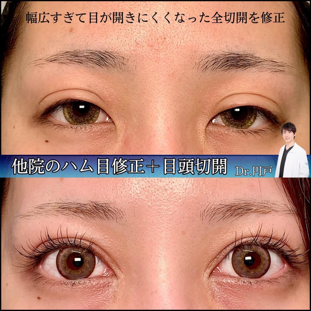 目元の他院修正と目頭切開の症例写真