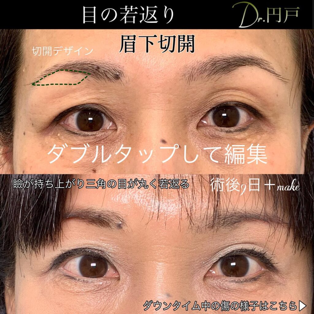 眉下切開の症例写真